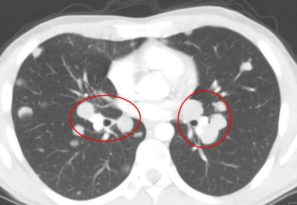 How To Interpret CT Scans Of Your Lung how-to-interpret-ct-scans-of-your-lung